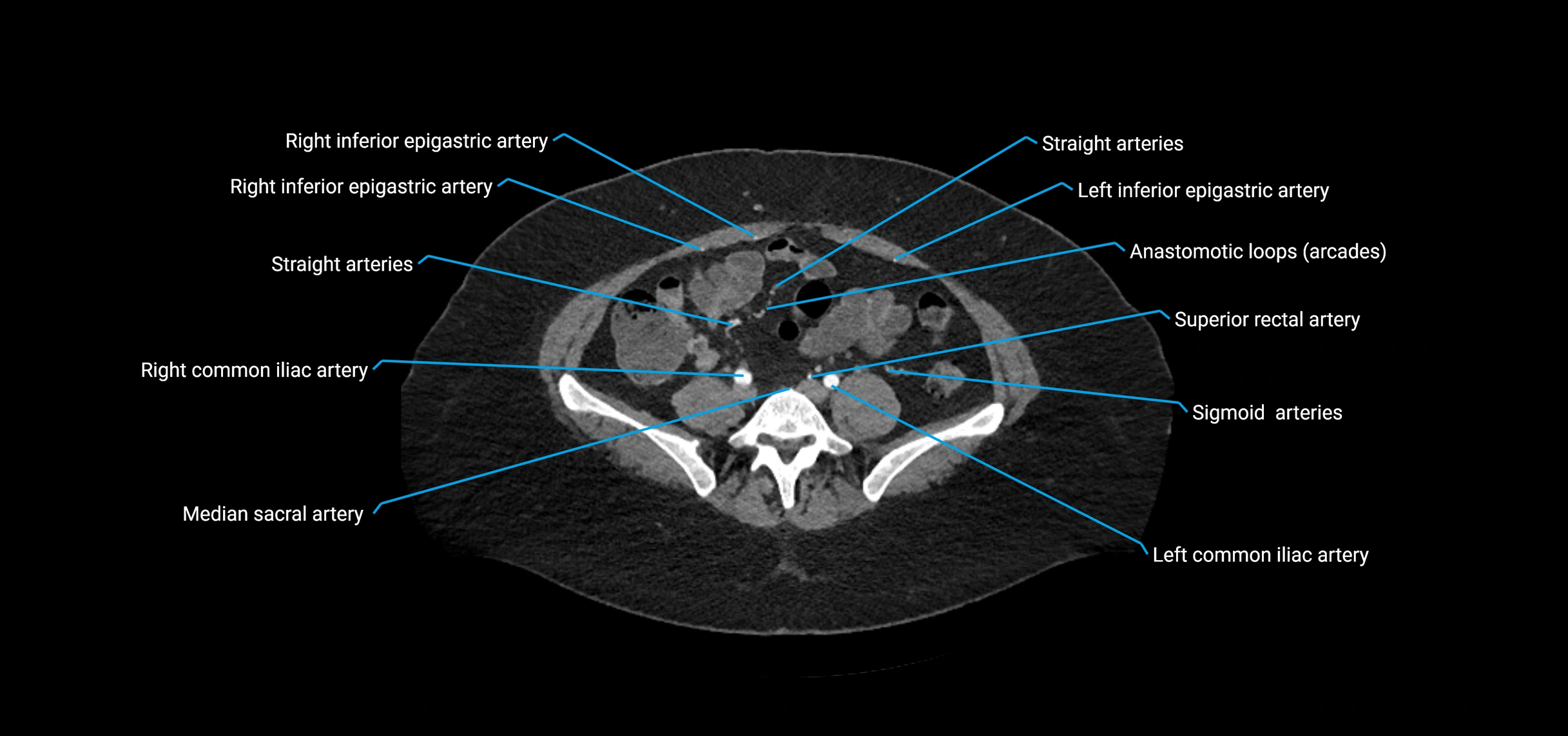 CTA abdomen axial cross sectional anatomy labelled image_165 (2).webp